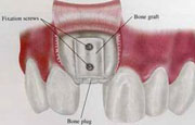 ложе-реципиент в передней части верхней челюсти с прикрепленным к нему блоком аутотрансплантата.