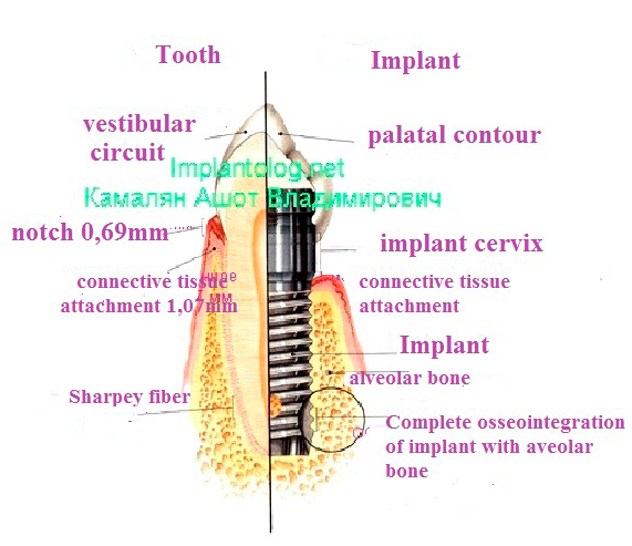 сравнение настоящего зуба с имплантантом
