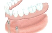 The removable teeth prosthesis fixation can be improved because here the implant performs a support function.