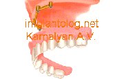 Имплантация зубов и фиксация с помощью балочной конструкции