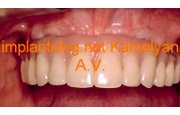 Имплантация зубов и фиксация с помощью балочной конструкции