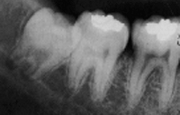 Вертикальный тип погружения зуба мудрости рентген