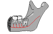 Вертикальный тип погружения зуба мудрости схема