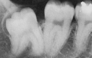 Дистальный тип погружения зуба мудрости рентген
