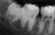 Вертикальный тип погружения зуба мудрости рентген