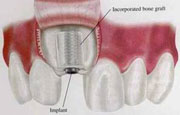 Изображение места подсадки костного блока на верхней челюсти с установленным имплантатом.