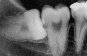 Горизонтальный тип погружения зуба мудрости рентген