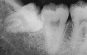 Медиальный тип погружения зуба мудрости рентген