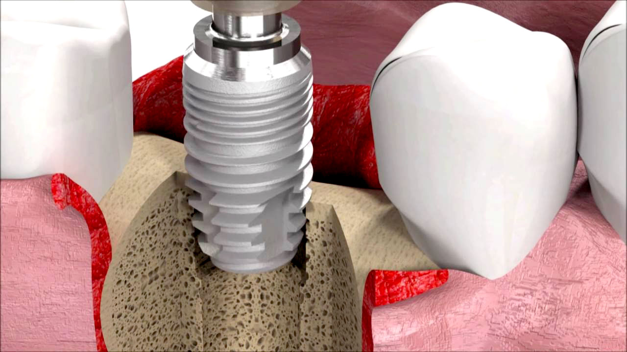 SIC invent Dental Implant procedure: SICMAX Implant insertion